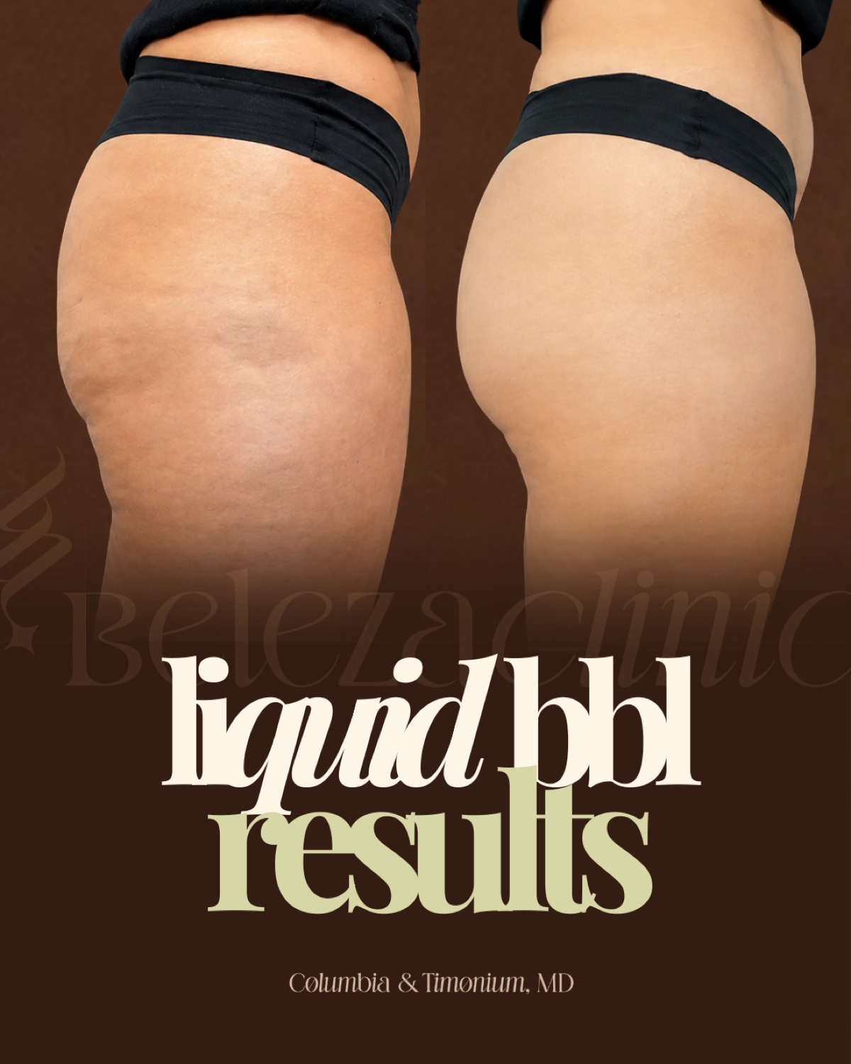 Liquid BBL patient results card