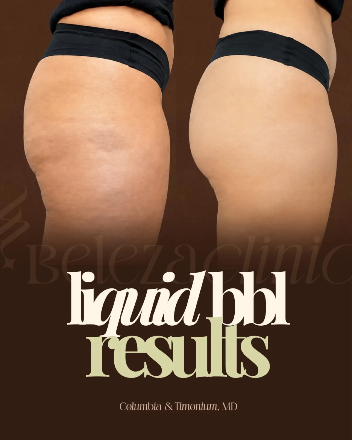 Liquid BBL patient results card
