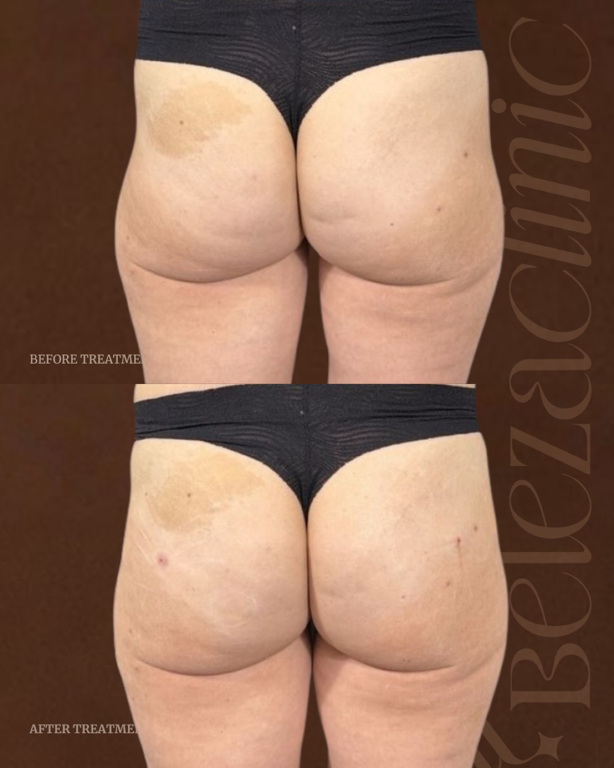 Liquid BBL before and after results at Beleza Clinic