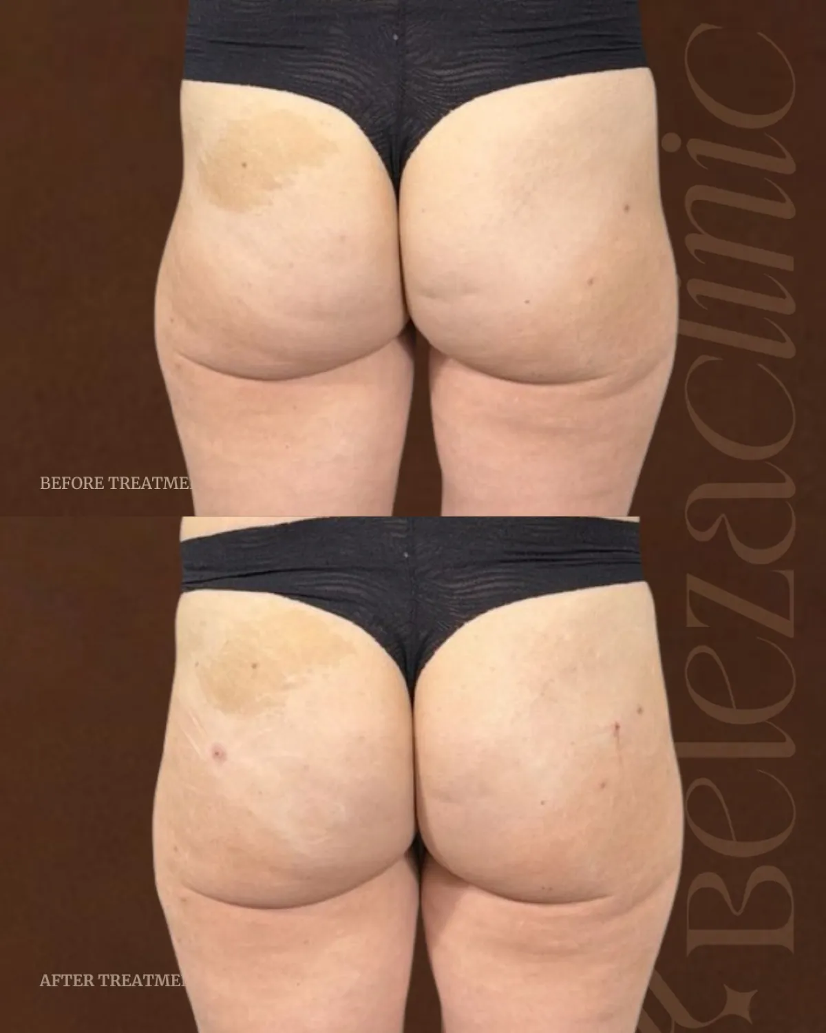 Liquid BBL before and after results at Beleza Clinic