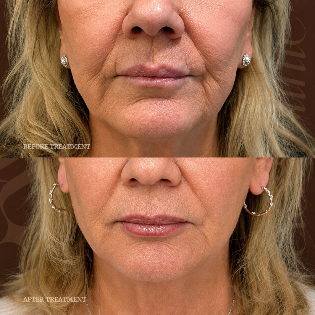 Before and after dermal filler treatment at Beleza Clinic