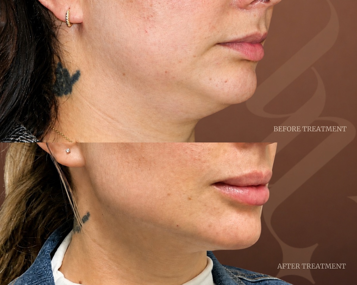 Before and after treatment result at Beleza Clinic
