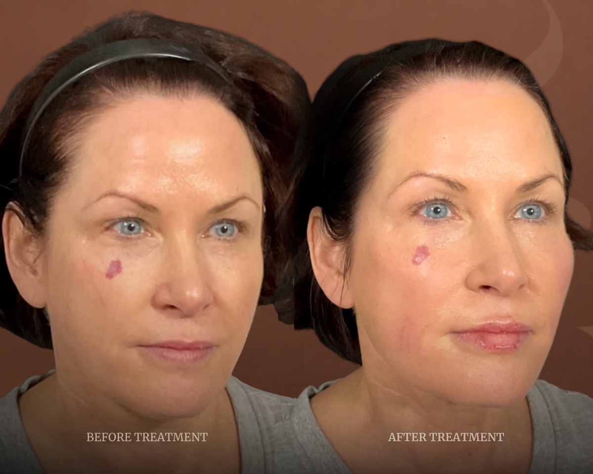 Before and after treatment result at Beleza Clinic