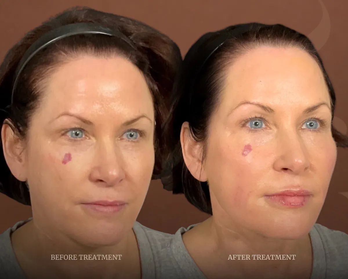 Before and after treatment result at Beleza Clinic