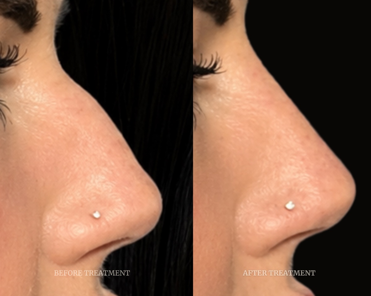 Before and after treatment result at Beleza Clinic