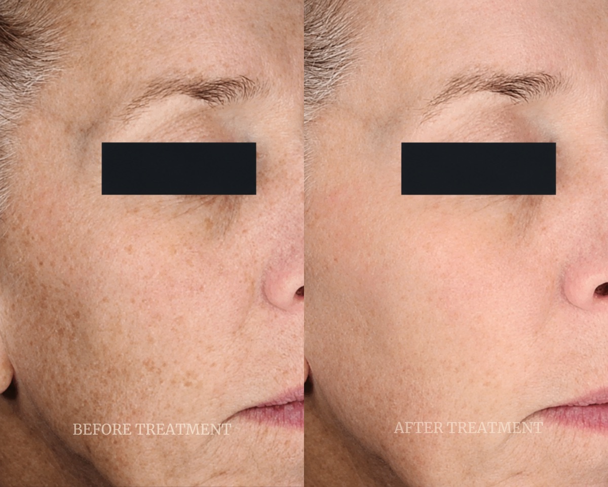 Before and after treatment result at Beleza Clinic