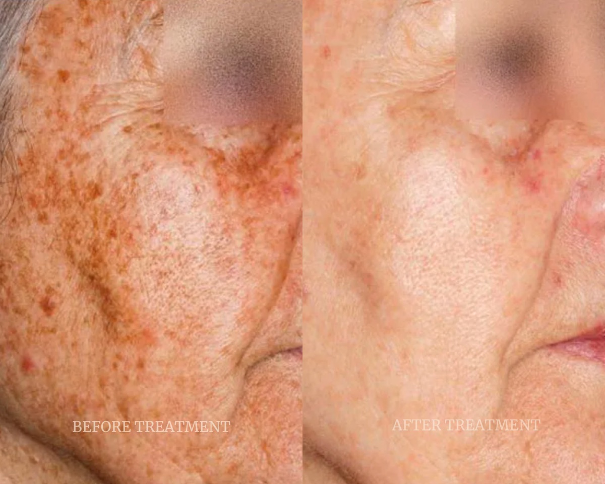 Before and after treatment result at Beleza Clinic