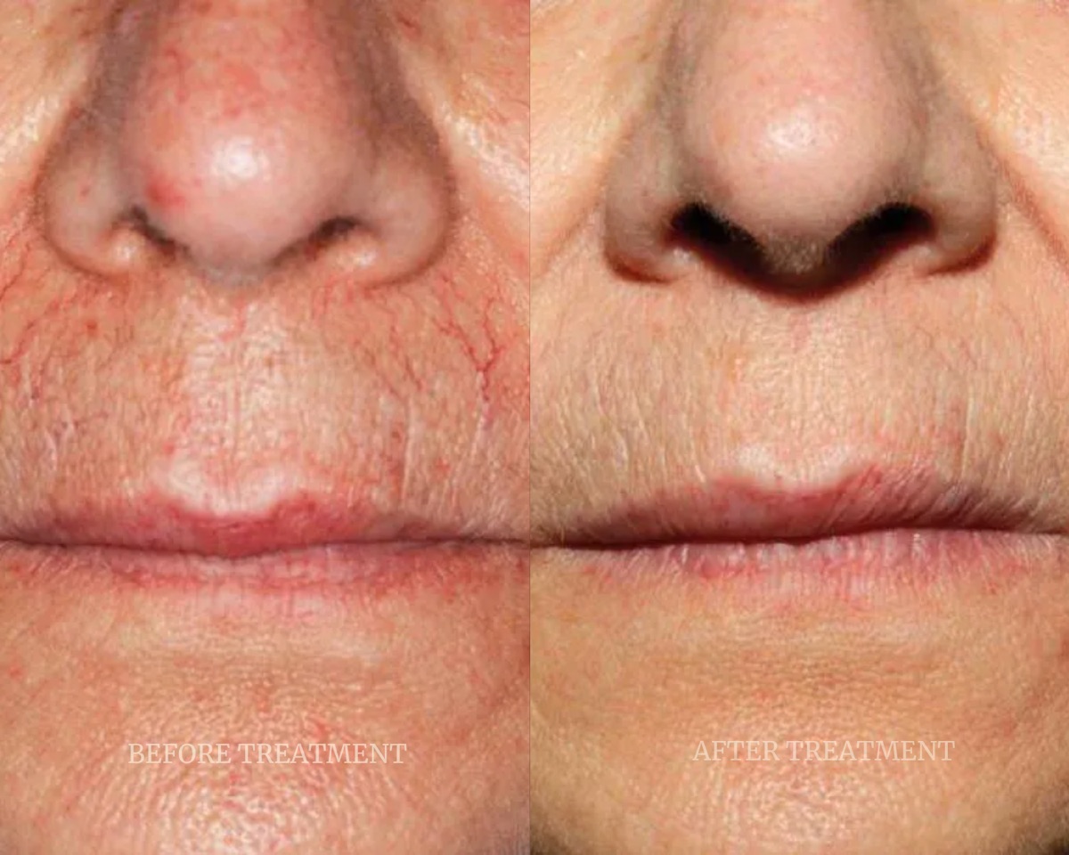 Before and after treatment result at Beleza Clinic