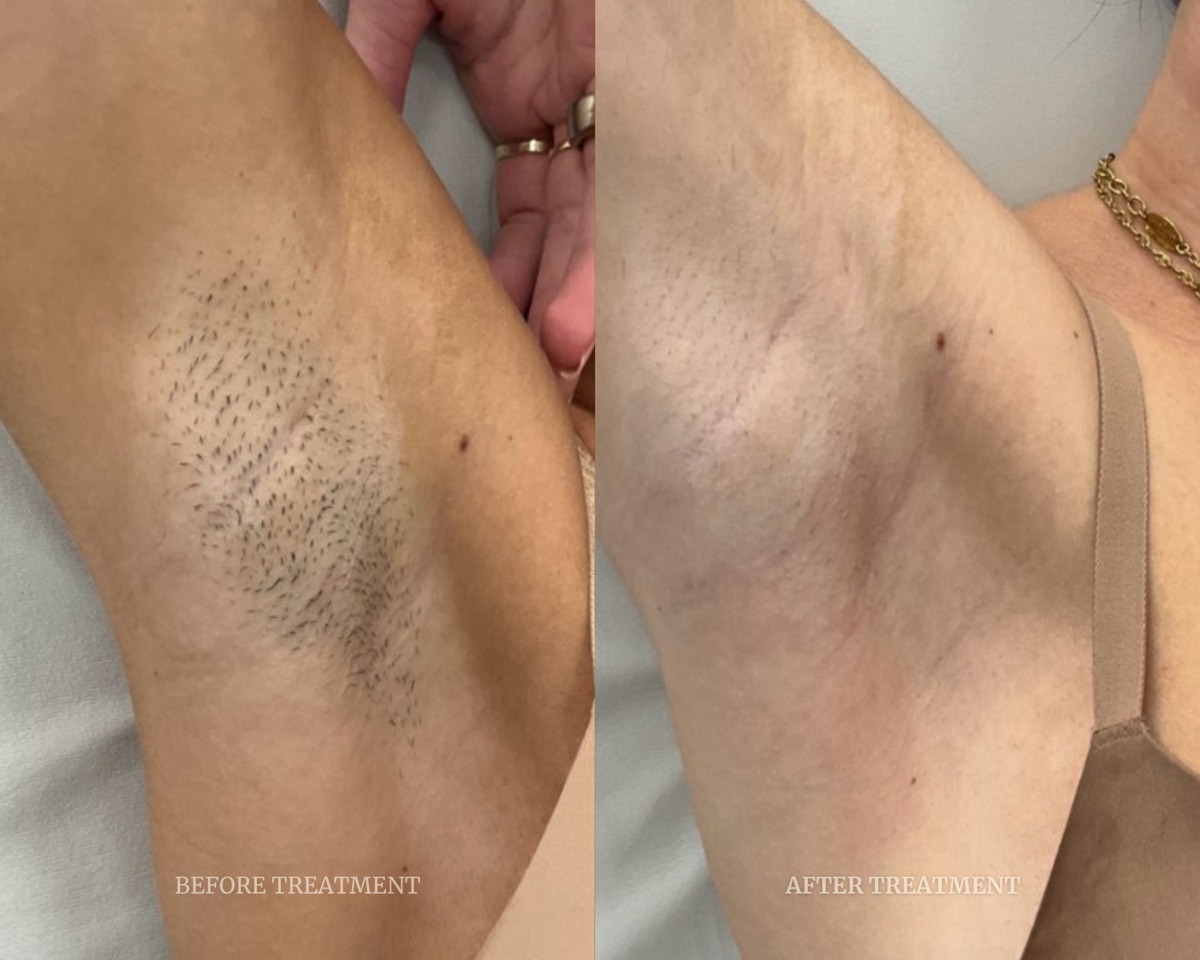 Before and after treatment result at Beleza Clinic