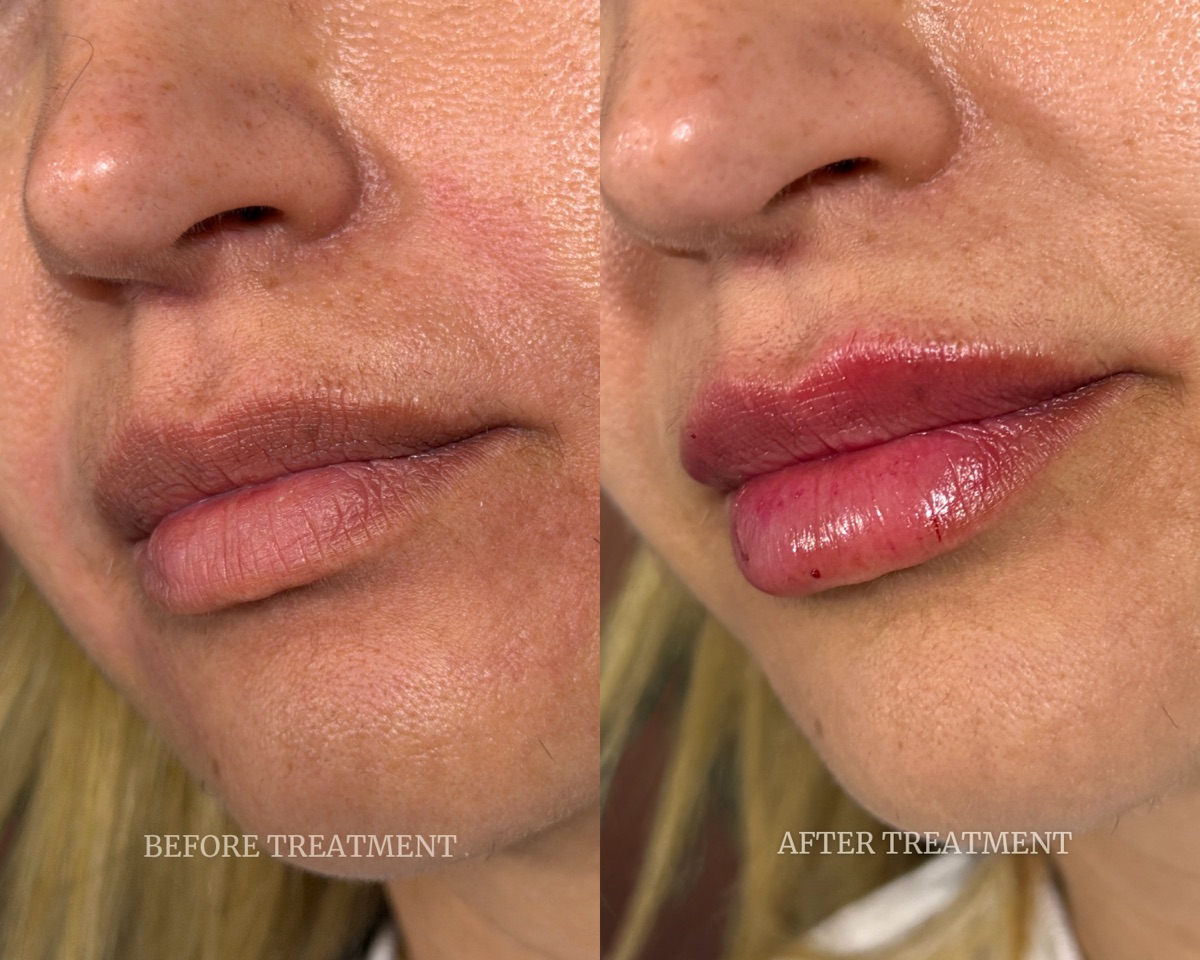 Before and after treatment result at Beleza Clinic