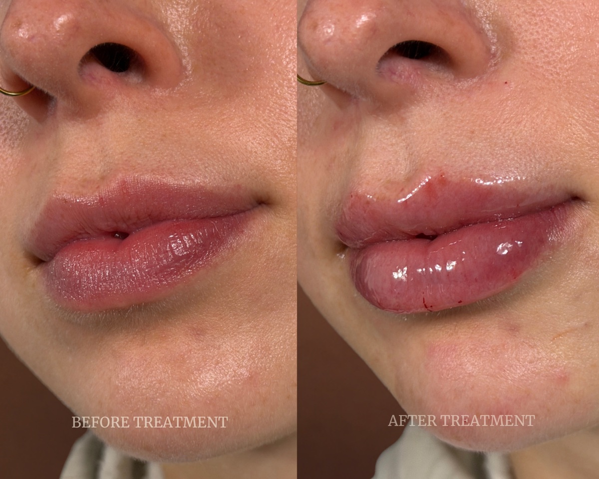 Before and after treatment result at Beleza Clinic