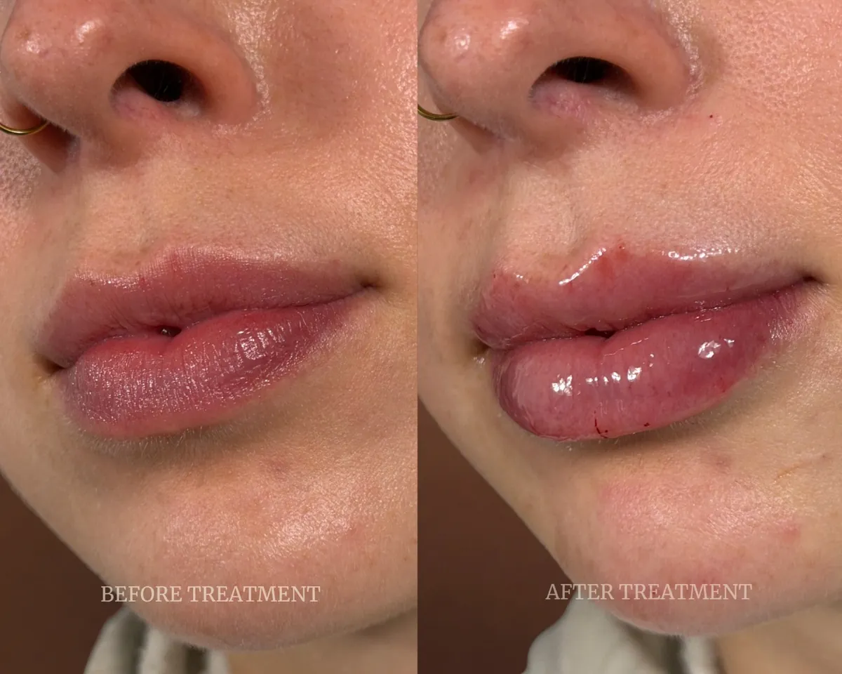 Before and after lip filler shape and volume