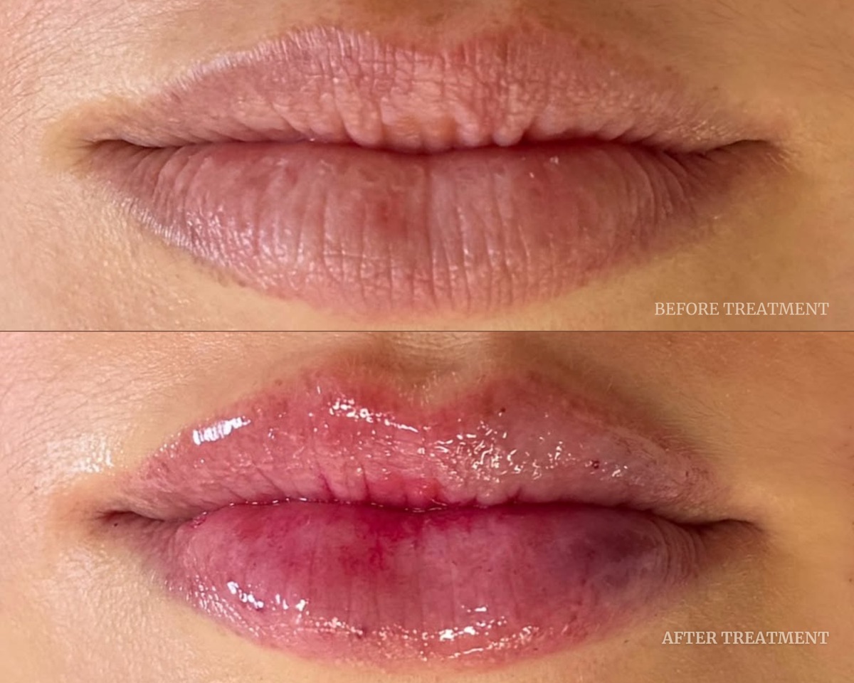 Before and after treatment result at Beleza Clinic