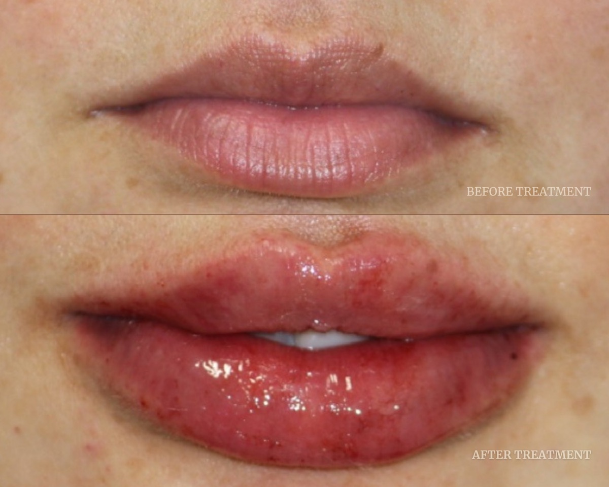 Before and after treatment result at Beleza Clinic