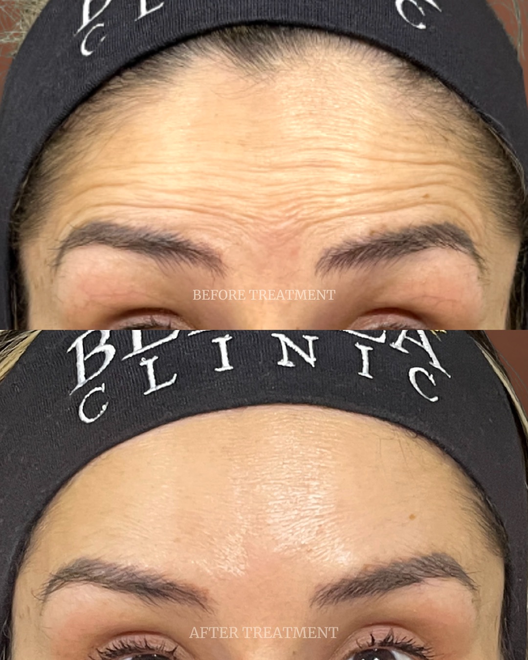 Before and after treatment result at Beleza Clinic