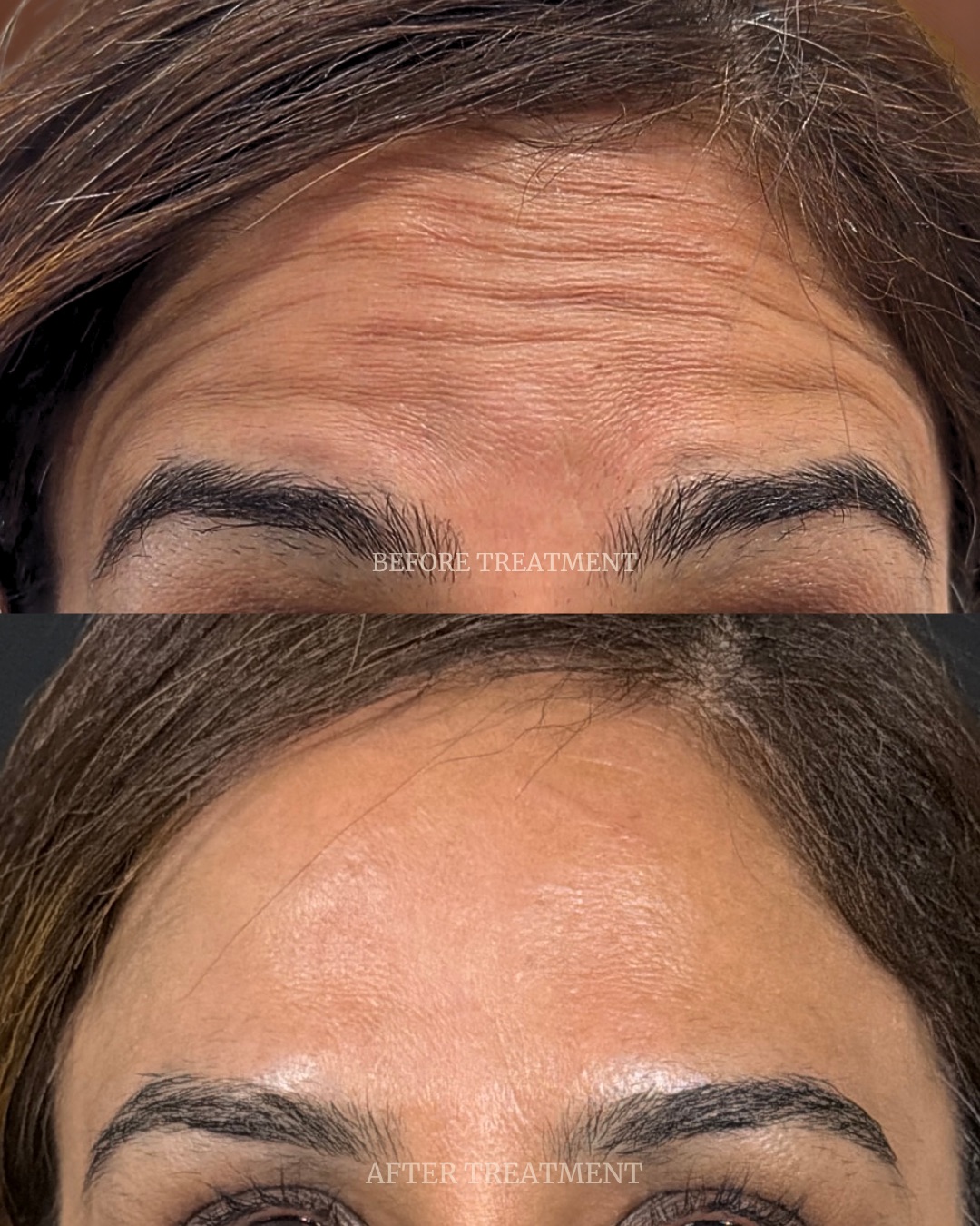 Before and after treatment result at Beleza Clinic