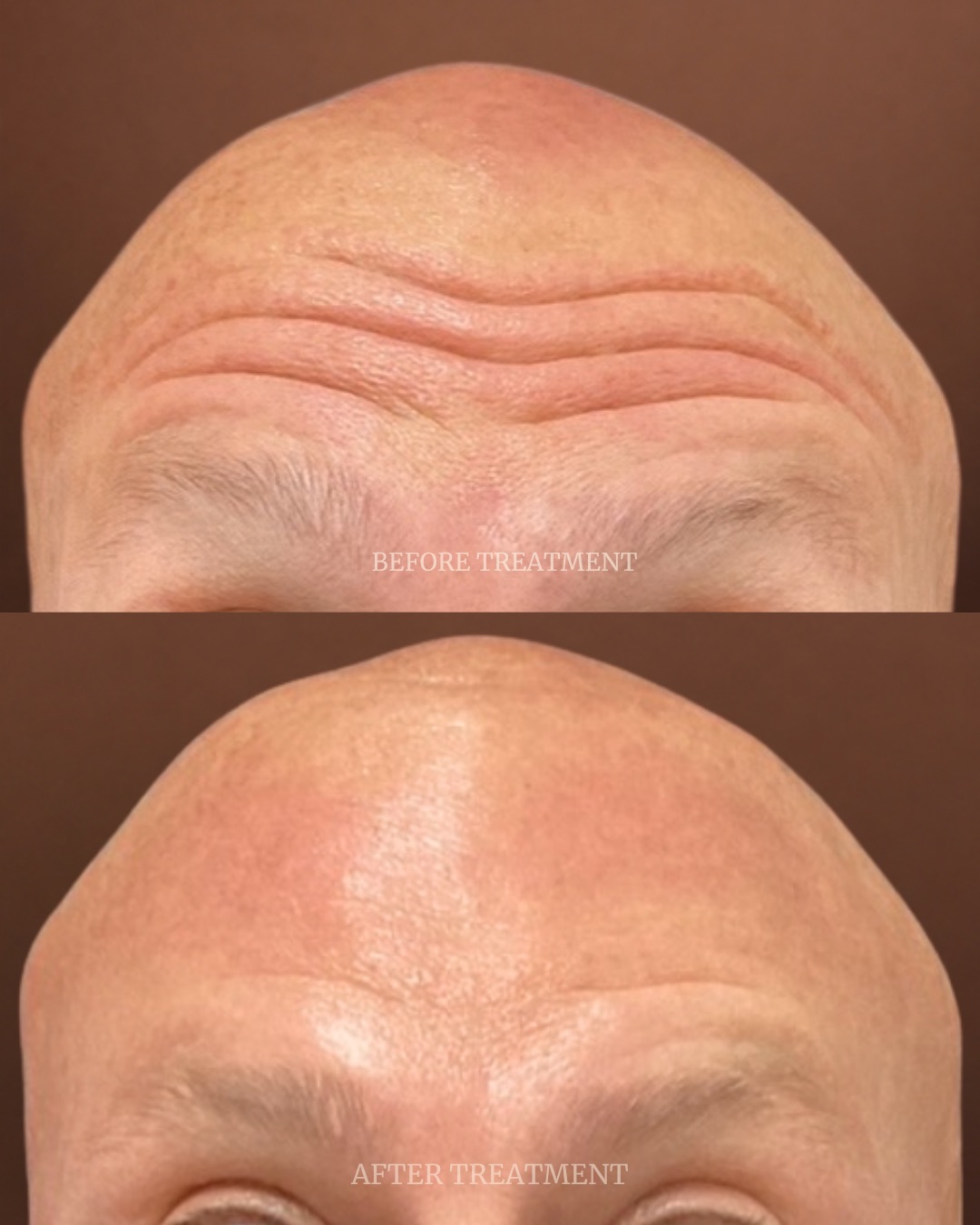 Before and after treatment result at Beleza Clinic