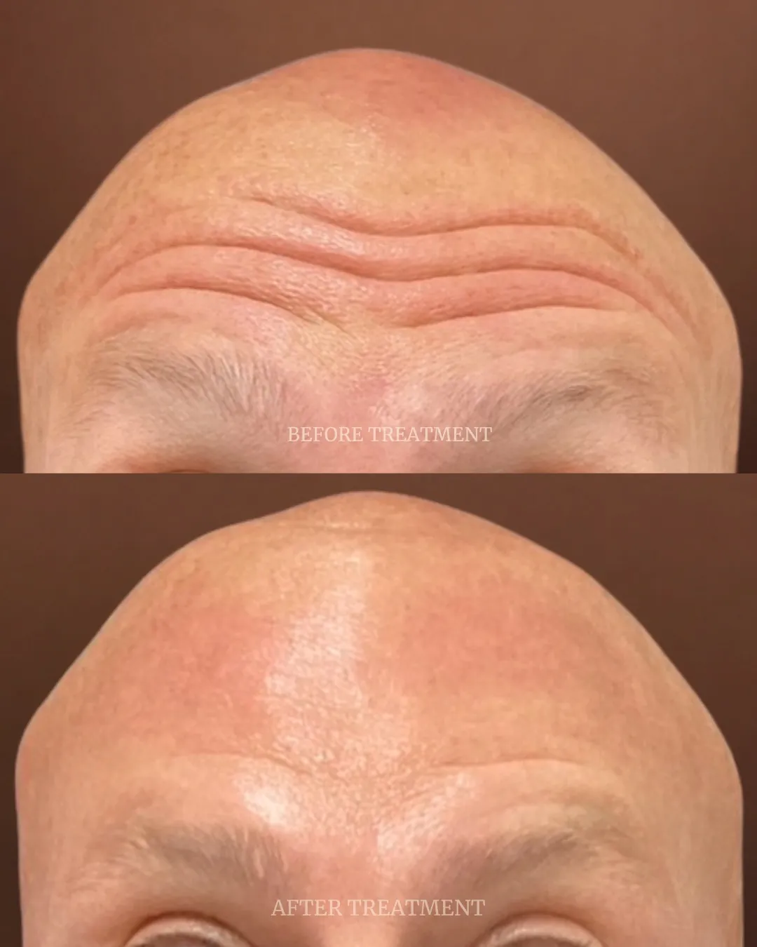 Before and after frown line treatment