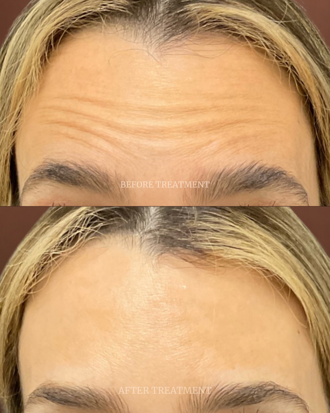 Before and after treatment result at Beleza Clinic