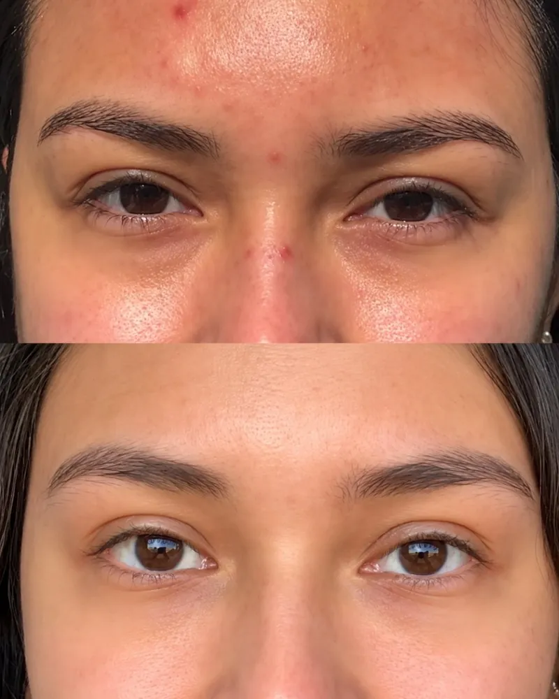 Microneedling before and after at Beleza Clinic