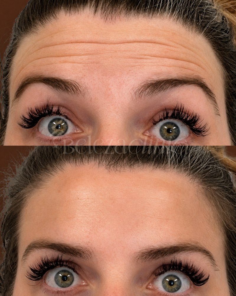 Neurotoxin before and after at Beleza Clinic