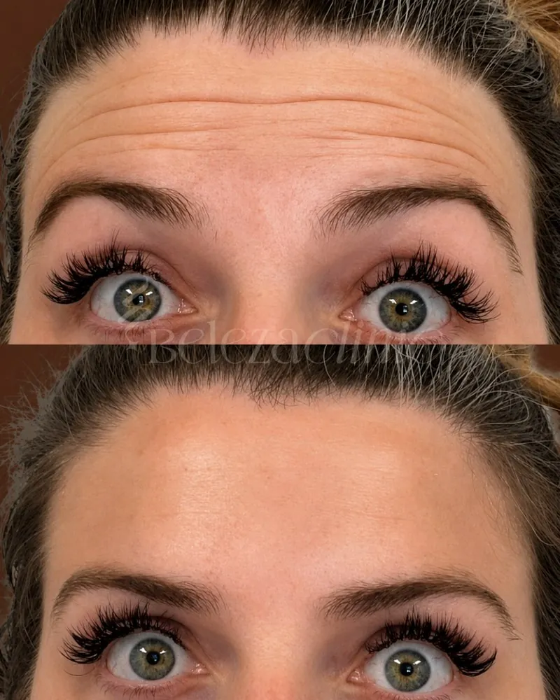 Neurotoxin before and after at Beleza Clinic