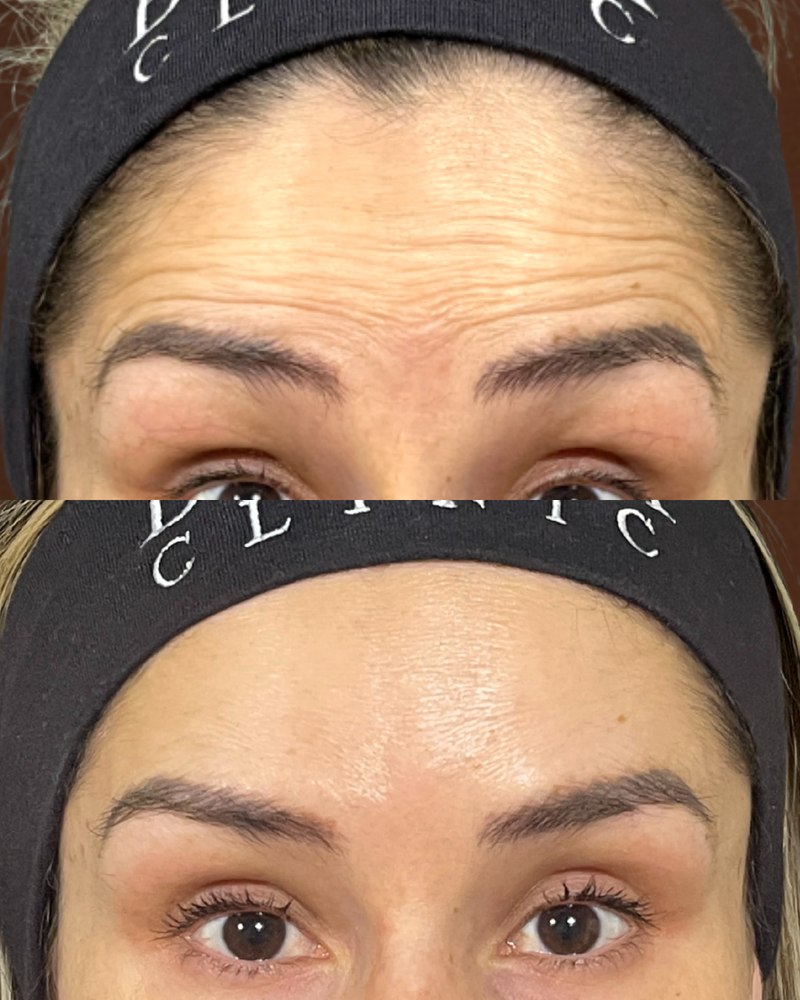 Neurotoxin before and after at Beleza Clinic