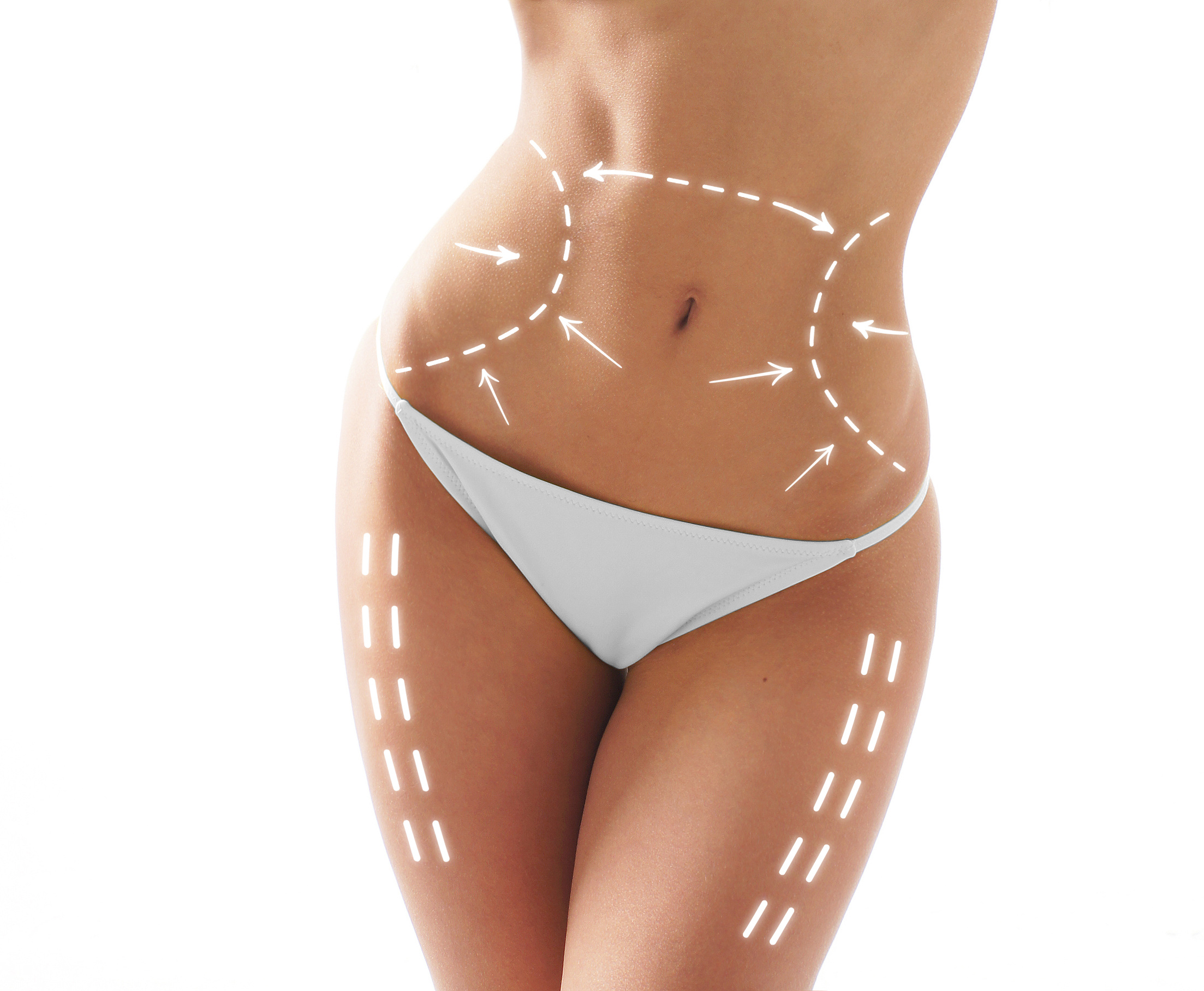 Female body with the drawing arrows on it isolated on white. Fat lose, liposuction and cellulite removal concept.